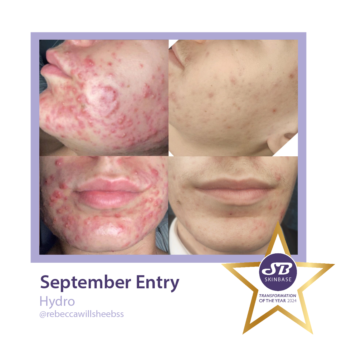 Hydro Before and After acne
