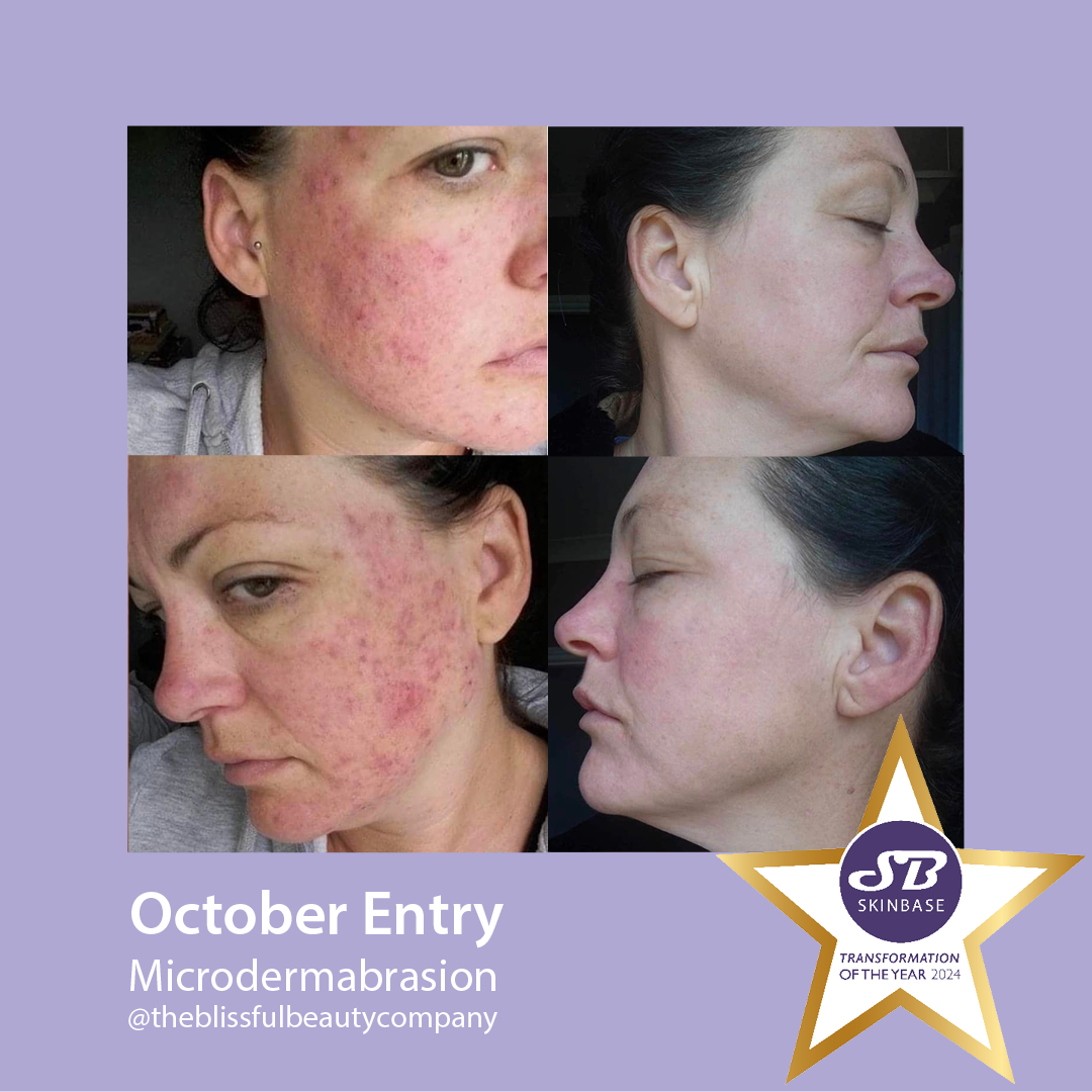 Before and after acne