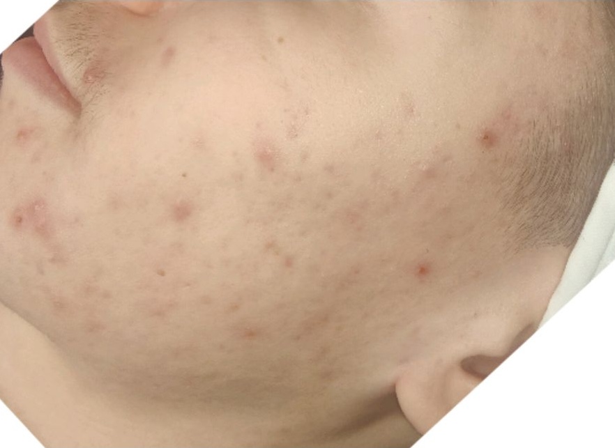 before and after skinbase hydro rebecca willshee nail and beauty specialist 2