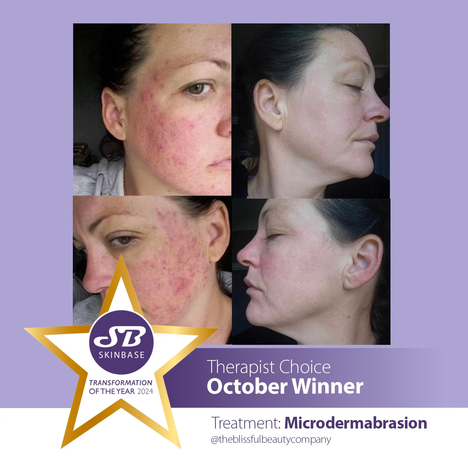 Before and after microdermabrasion