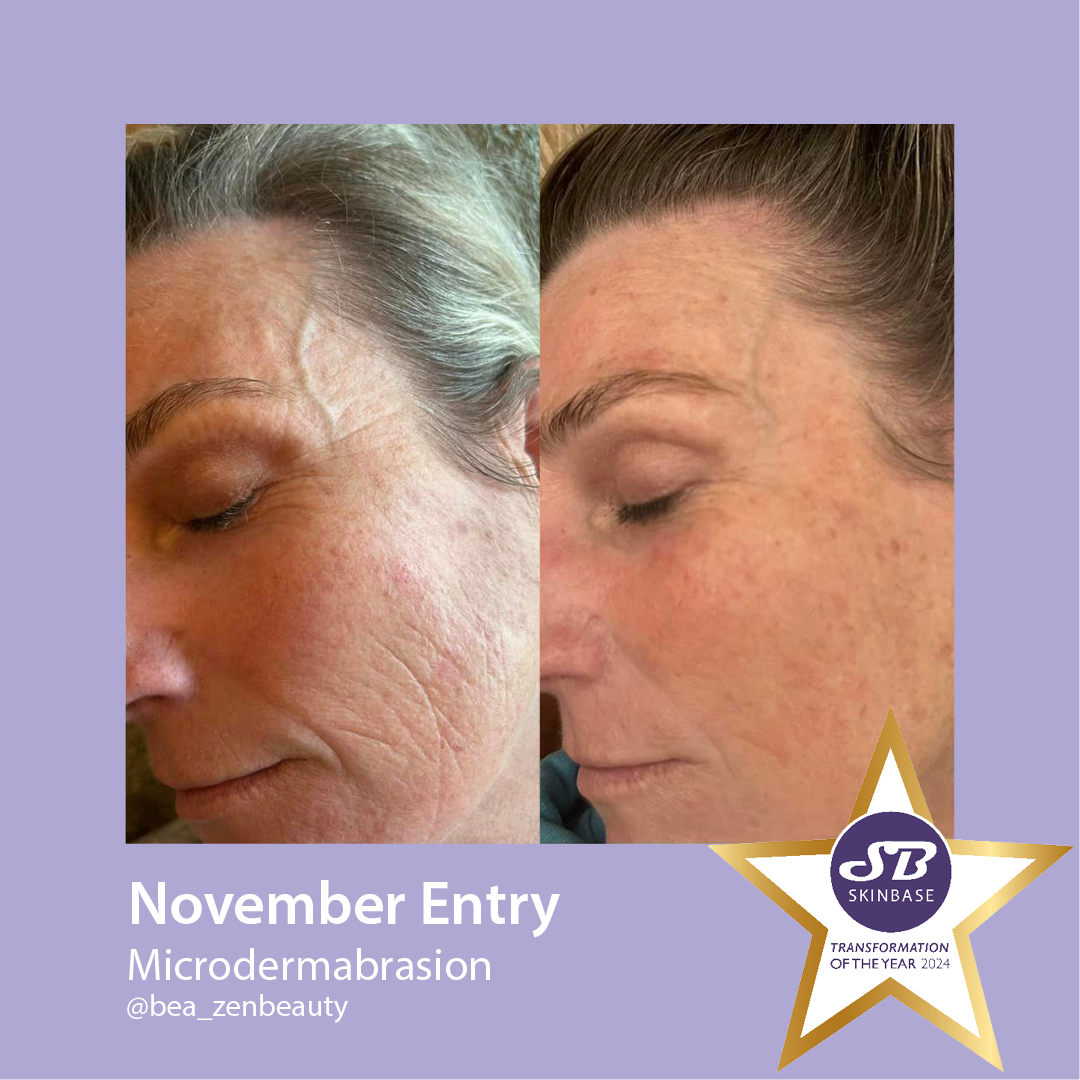 Microdermabrasion before and after