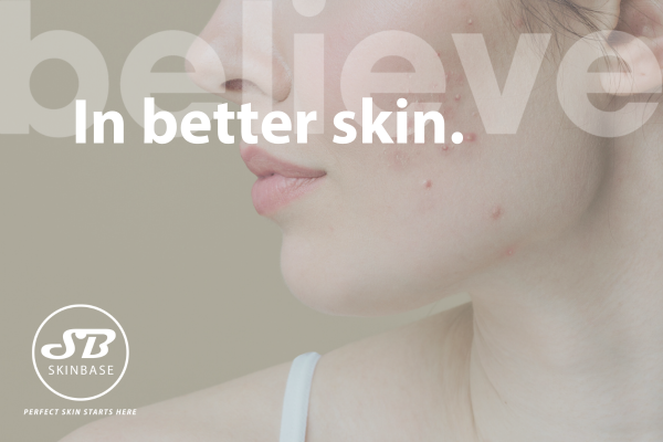 believe in better skin: understanding acne