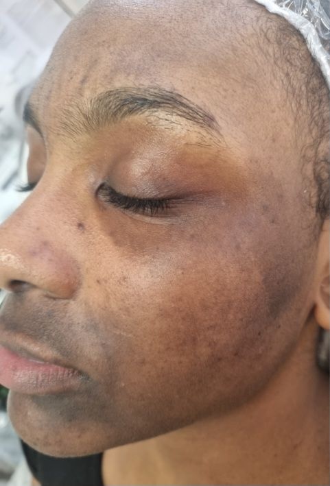 Hydro facial pigmentation treatment before and after Solution Skin Clinic 1
