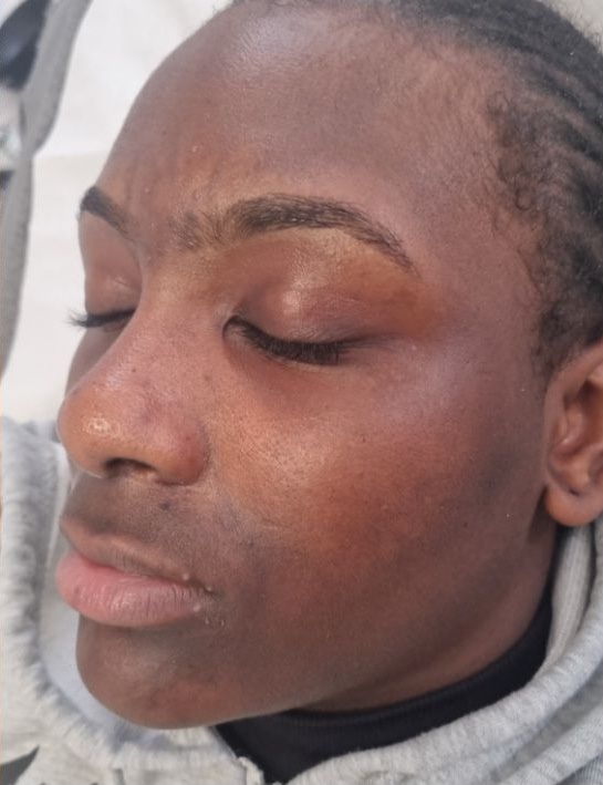 Hydro facial pigmentation treatment before and after Solution Skin Clinic 2