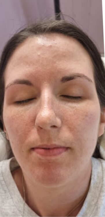 PCOS facial before and after microdermabrasion SkinBase Collagen Lift 1
