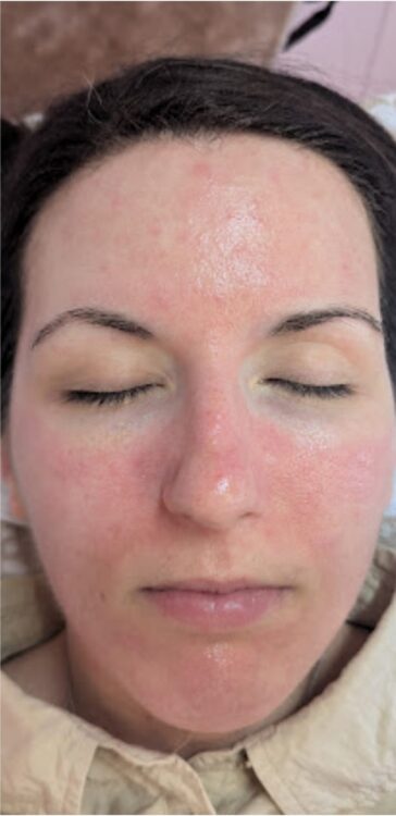 PCOS facial before and after microdermabrasion SkinBase Collagen Lift 2