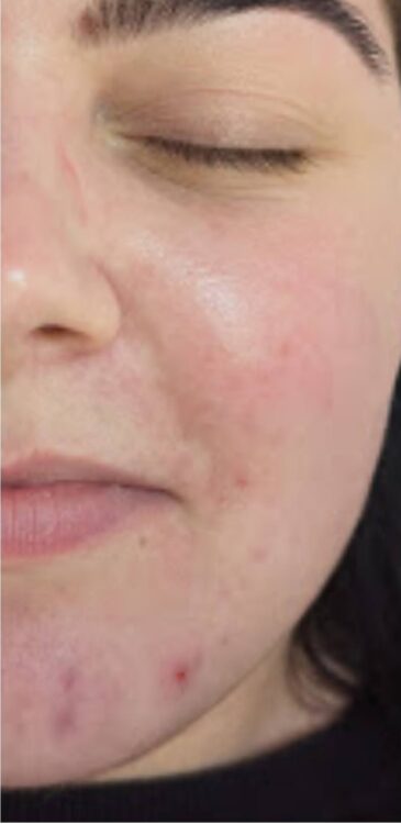 SkinBase Intense Pulsed Light for acne results Glam Beauty Education 1