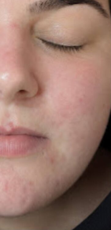SkinBase Intense Pulsed Light for acne results Glam Beauty Education 2