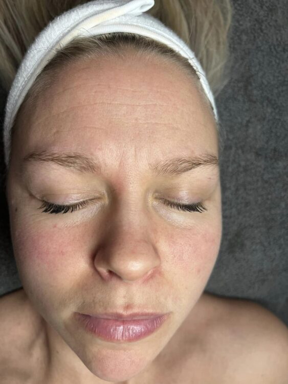 SkinBase before and after microdermabrasion for dull skin TLV Beauty 1