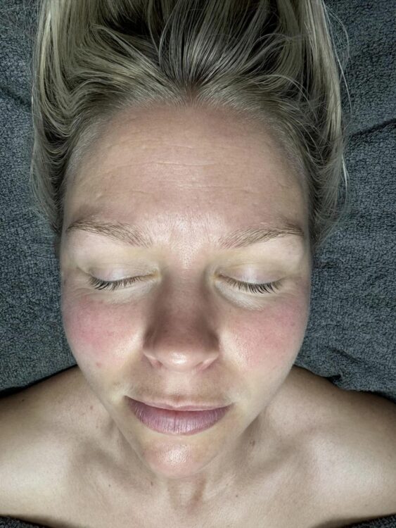 SkinBase before and after microdermabrasion for dull skin TLV Beauty 2