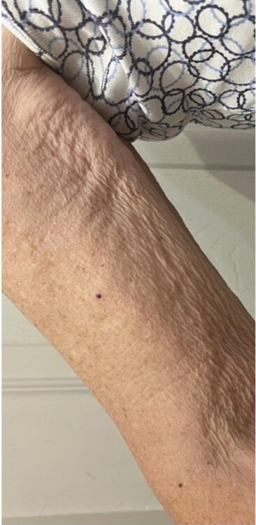SkinBase collagen lift radio-frequency for sagging skin on the arms - Natural Beauty by Natalie 1