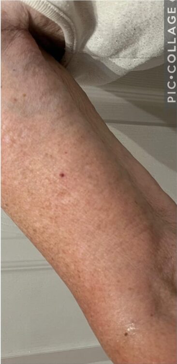 SkinBase collagen lift radio-frequency for sagging skin on the arms - Natural Beauty by Natalie 2