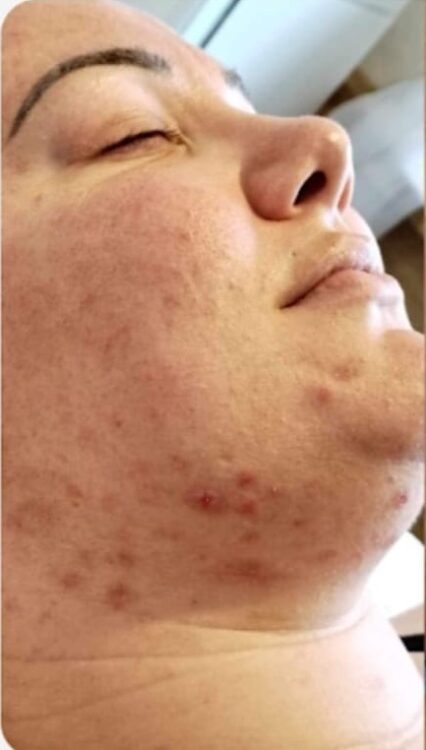 adult acne skin transformation SkinBase Microdermabrasion Lotus Beauty Lounge 1
