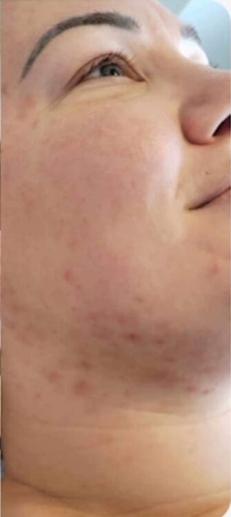 adult acne skin transformation SkinBase Microdermabrasion Lotus Beauty Lounge 2