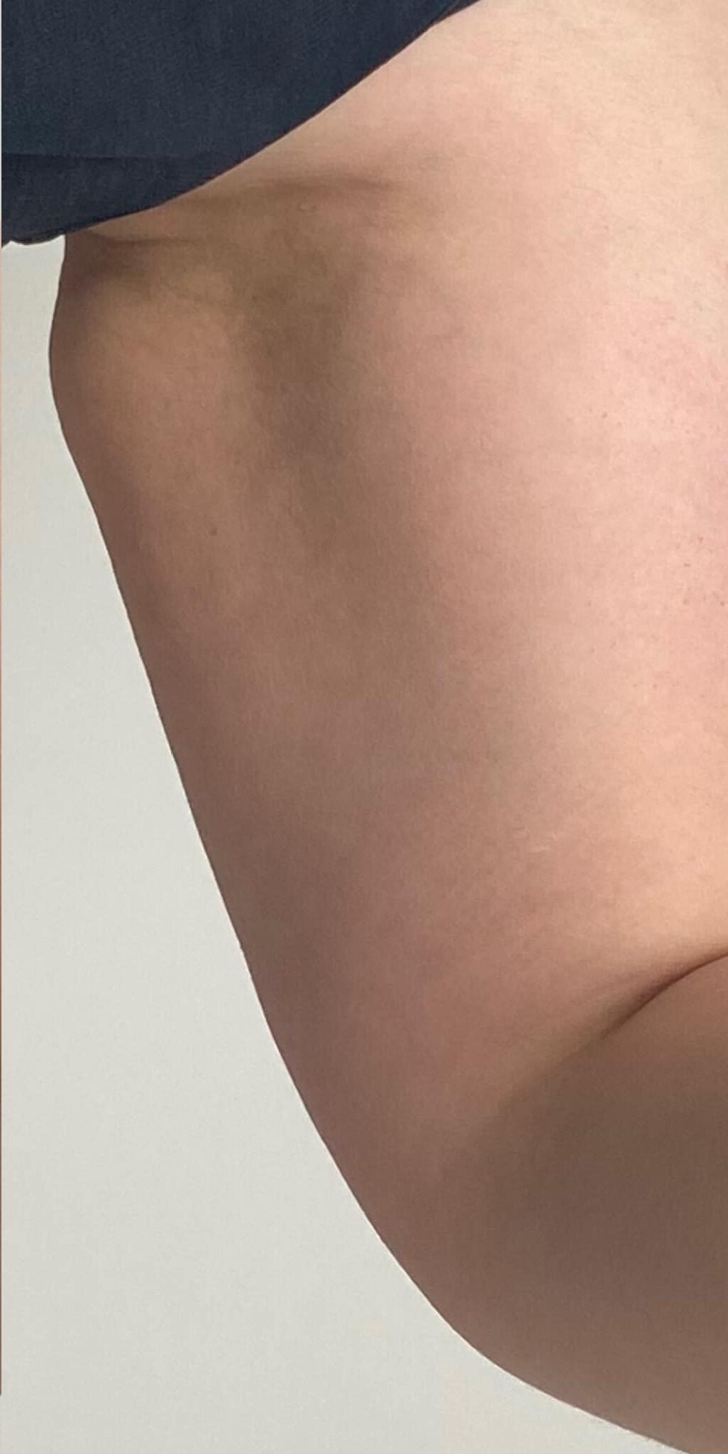 arm firming radio-frequency treatment results Gaynor Louise Beauty & Aesthetics 1