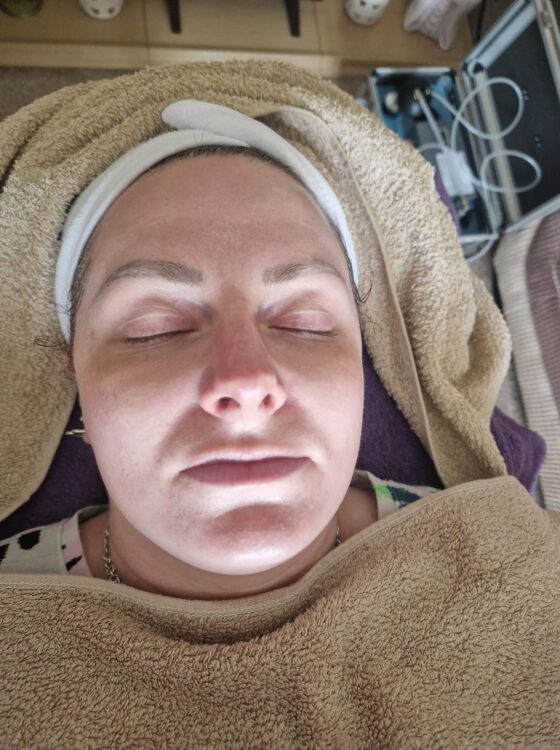 before and after Microdermabrasion - clearer skin in 30 minutes Harmony Holistics 1