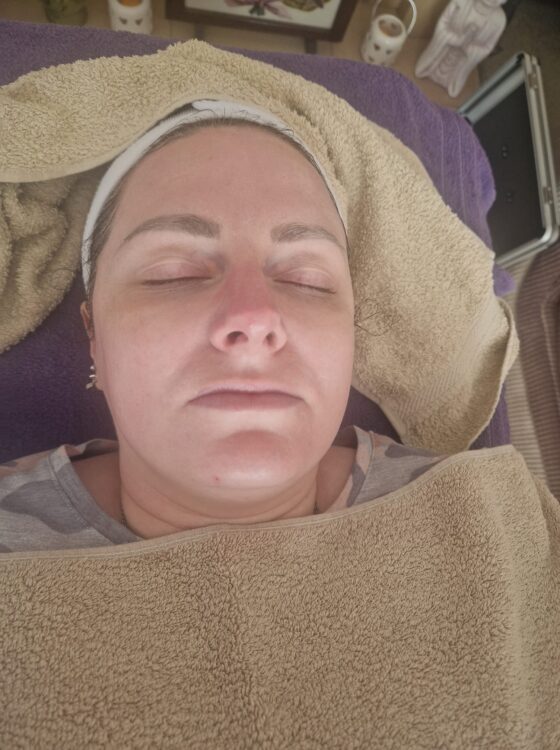 before and after Microdermabrasion - clearer skin in 30 minutes Harmony Holistics 2