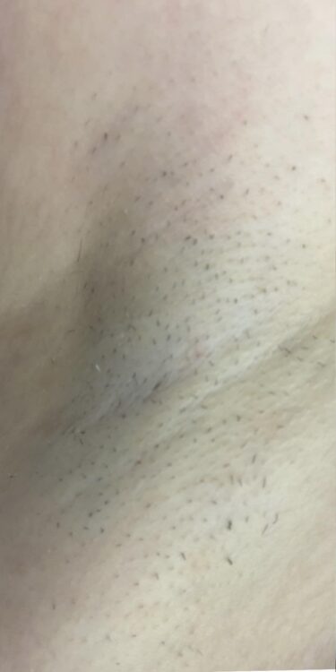 before and after SkinBase ipl hair reduction Lauren's Beauty & Massage 1