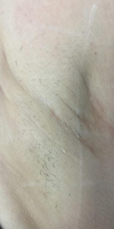 before and after SkinBase ipl hair reduction Lauren's Beauty & Massage 2