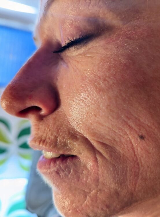 before and after SkinBase microdermabrasion for sun damaged skin - Gaby Massage & Beauty 1