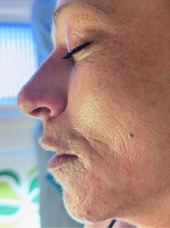 before and after SkinBase microdermabrasion for sun damaged skin - Gaby Massage & Beauty 2