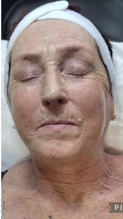 before and after a radio frequency facial for fine lines and wrinkles Finishing Touches Beauty SkinBase 1