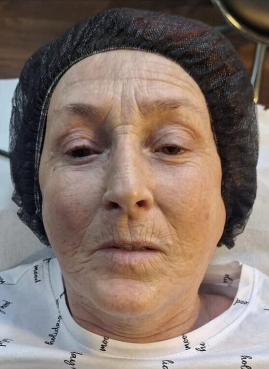 before and after a radio frequency facial for fine lines and wrinkles Finishing Touches Beauty SkinBase 2