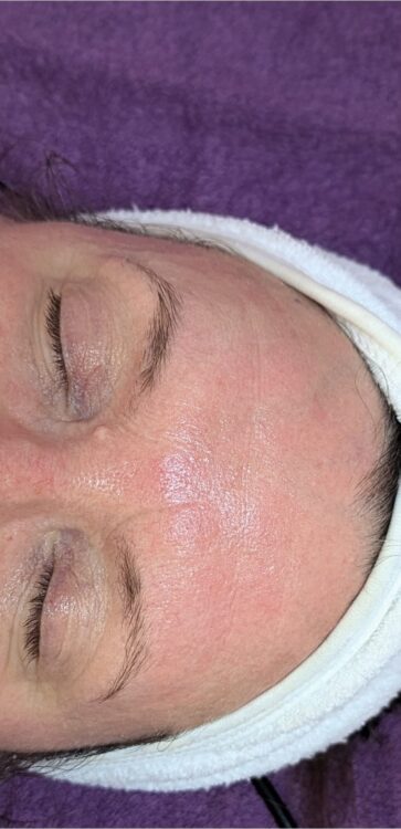 before and after collagen lift for fine lines and wrinkles Glam Beauty Education 2