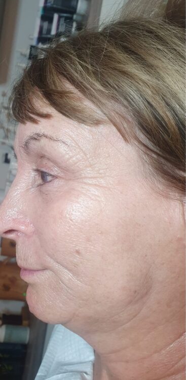 before and after collagen lift for sagging jowls SkinBase Anna's Beauty Centre 1