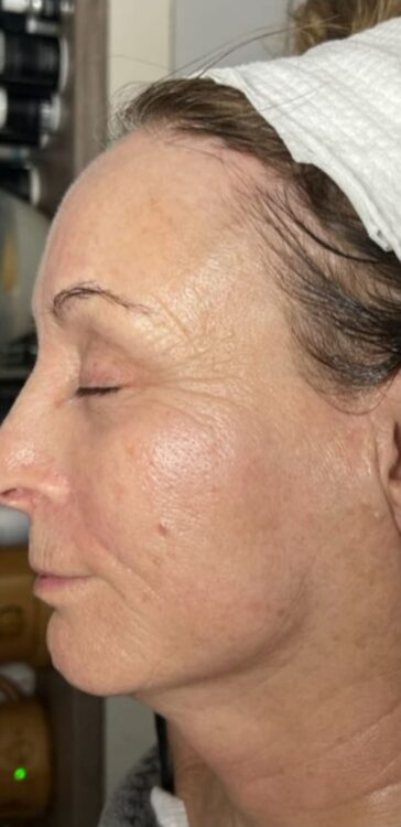 before and after collagen lift for sagging jowls SkinBase Anna's Beauty Centre