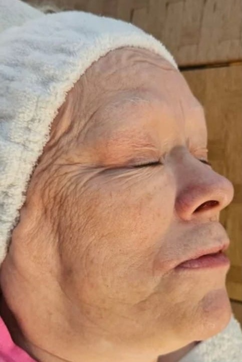 before and after hydro facial for ageing skin SkinBase Bobbi Brooklyn Aesthetics Clinic 1