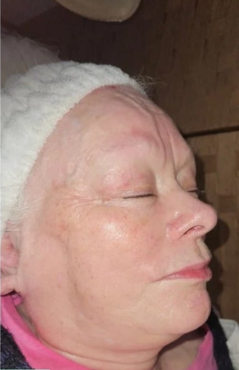 before and after hydro facial for ageing skin SkinBase Bobbi Brooklyn Aesthetics Clinic 2