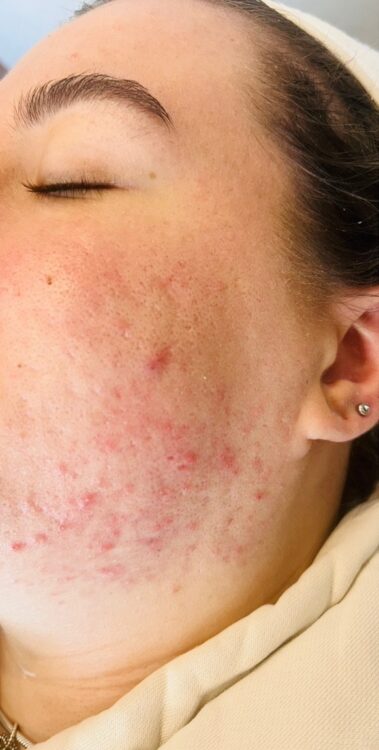 before and after microdermabrasion for congested skin - SkinBase - Glow UK Beauty Therapy 1