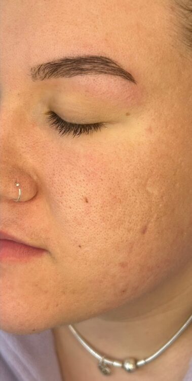 before and after microdermabrasion for congested skin - SkinBase - Glow UK Beauty Therapy 2