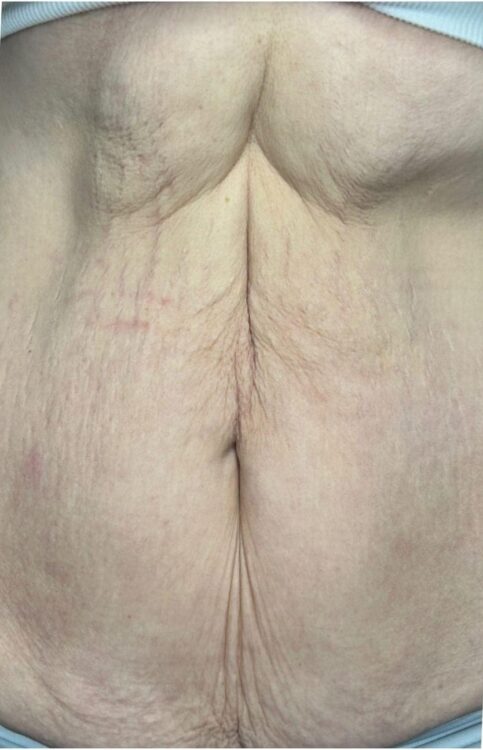 before and after radio frequency for loose skin on the tummy - SkinBase Collagen Lift Pure Skin Clinic 1