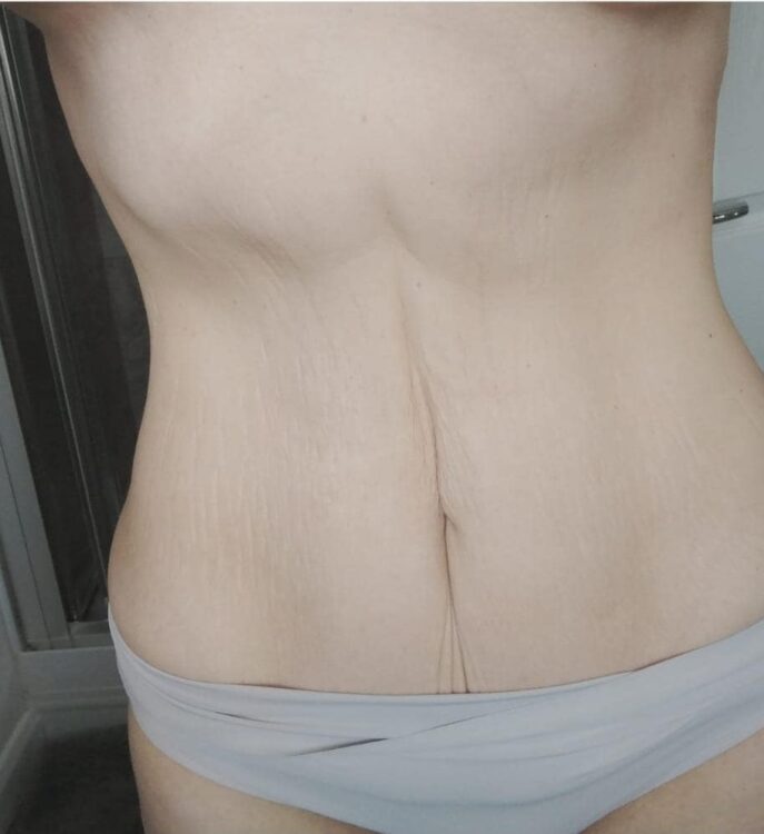 before and after radio frequency for loose skin on the tummy - SkinBase Collagen Lift Pure Skin Clinic 2