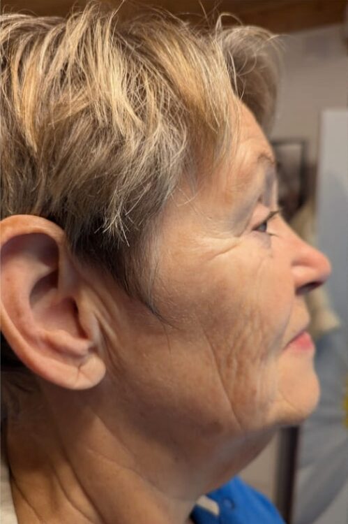 before and after radio frequency treatment for radient skin Gaby Massage and Beauty 1