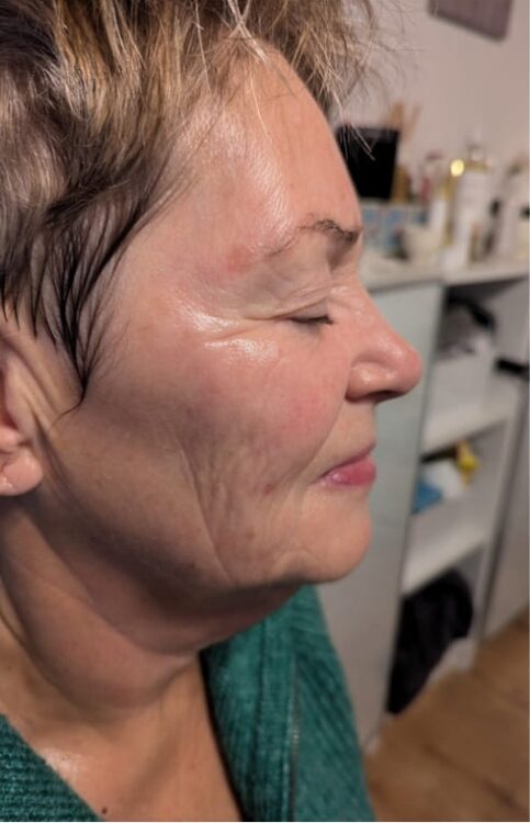 before and after radio frequency treatment for radient skin Gaby Massage and Beauty 2