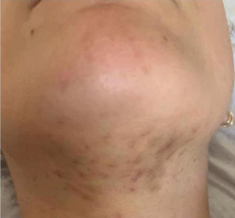 before and after skinbase microdermabrasion for pigmentation results the blissful beauty company 1