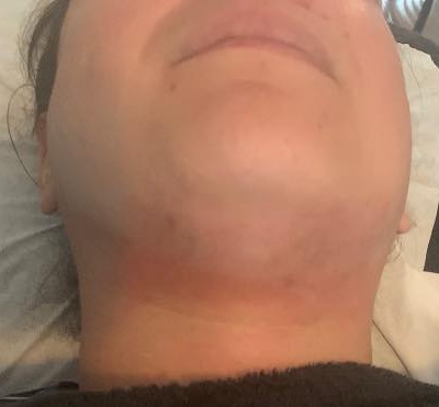 before and after skinbase microdermabrasion for pigmentation results the blissful beauty company 2