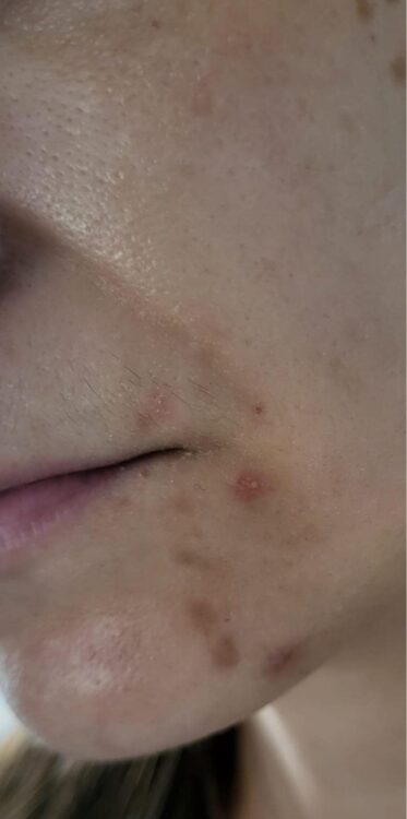 best pre wedding acne scarring treatment before and after SkinBase Microdermabrasion twinkle with glamour 1