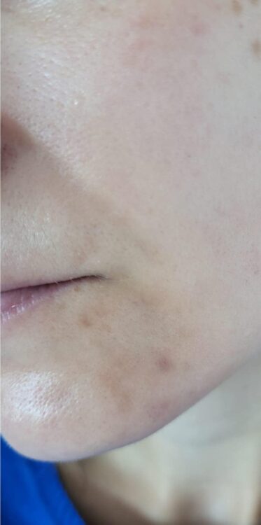 best pre wedding acne scarring treatment before and after SkinBase Microdermabrasion twinkle with glamour 2