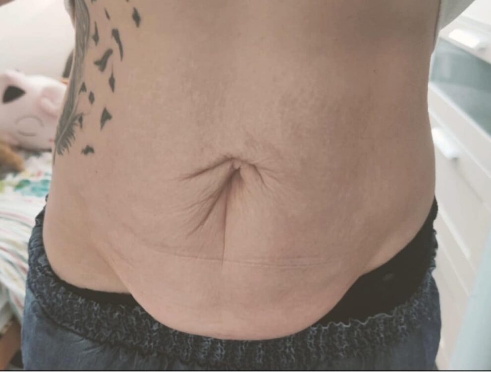 best treatment for sagging skin on tummy - SkinBase Collagen Lift results Wood & Co Salon & Beauty 1
