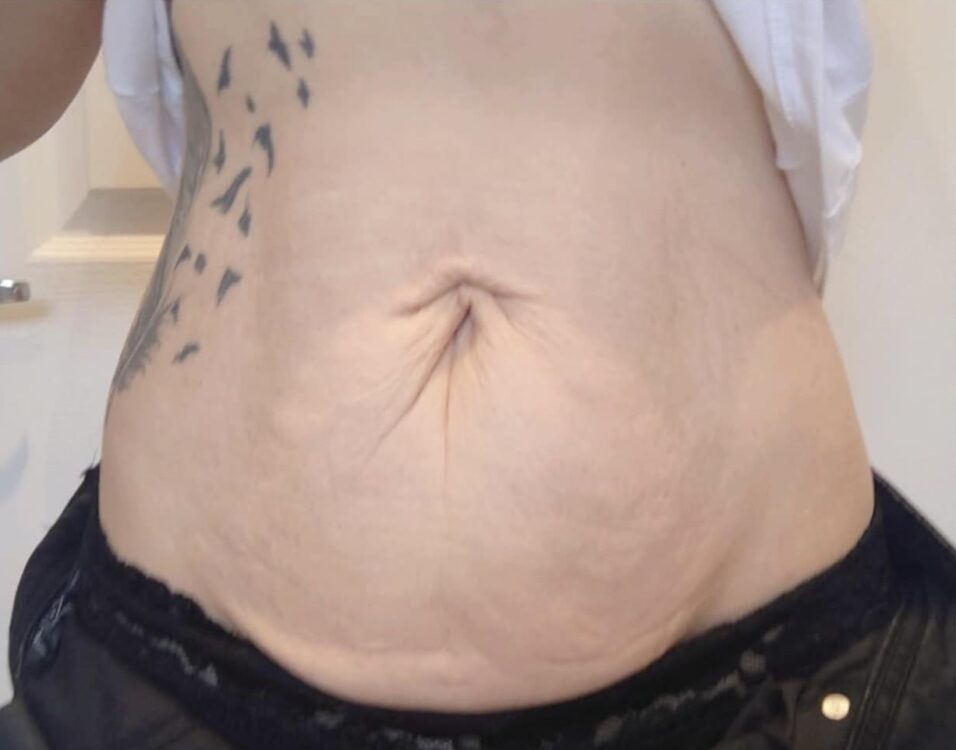 best treatment for sagging skin on tummy - SkinBase Collagen Lift results Wood & Co Salon & Beauty 2