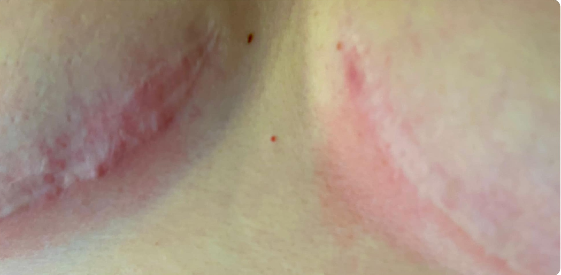 best treatment to minimise the appearance of scarring SkinBase IPL Rejuvenation 1