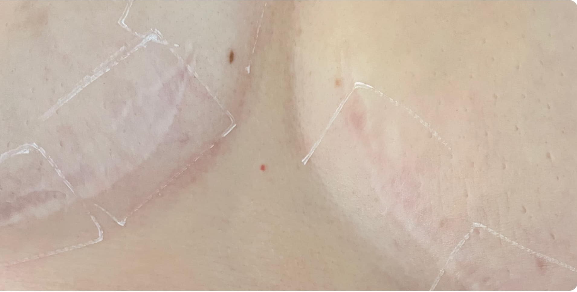 best treatment to minimise the appearance of scarring SkinBase IPL Rejuvenation 2