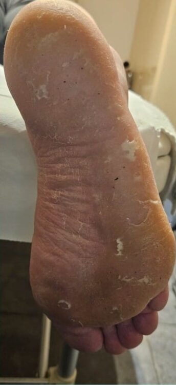 dry cracked feet microdermabrasion pedicure results Bobbi Brooklyn Aesthetics Clinic SkinBase 1