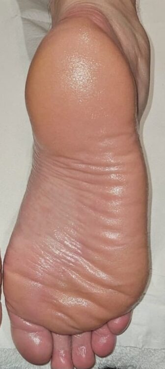 dry cracked feet microdermabrasion pedicure results Bobbi Brooklyn Aesthetics Clinic SkinBase 2
