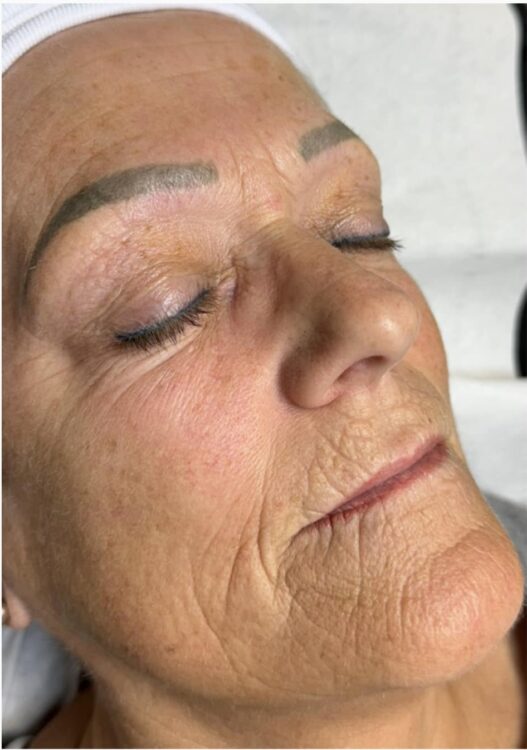 fine lines and wrinkles around the mouth rejuvenation SkinBase Collagen Lift The Beauty Lounge 1