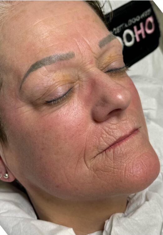 fine lines and wrinkles around the mouth rejuvenation SkinBase Collagen Lift The Beauty Lounge 2
